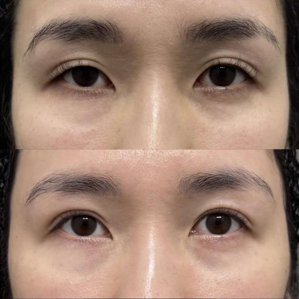 全切開二重術＋眼瞼下垂