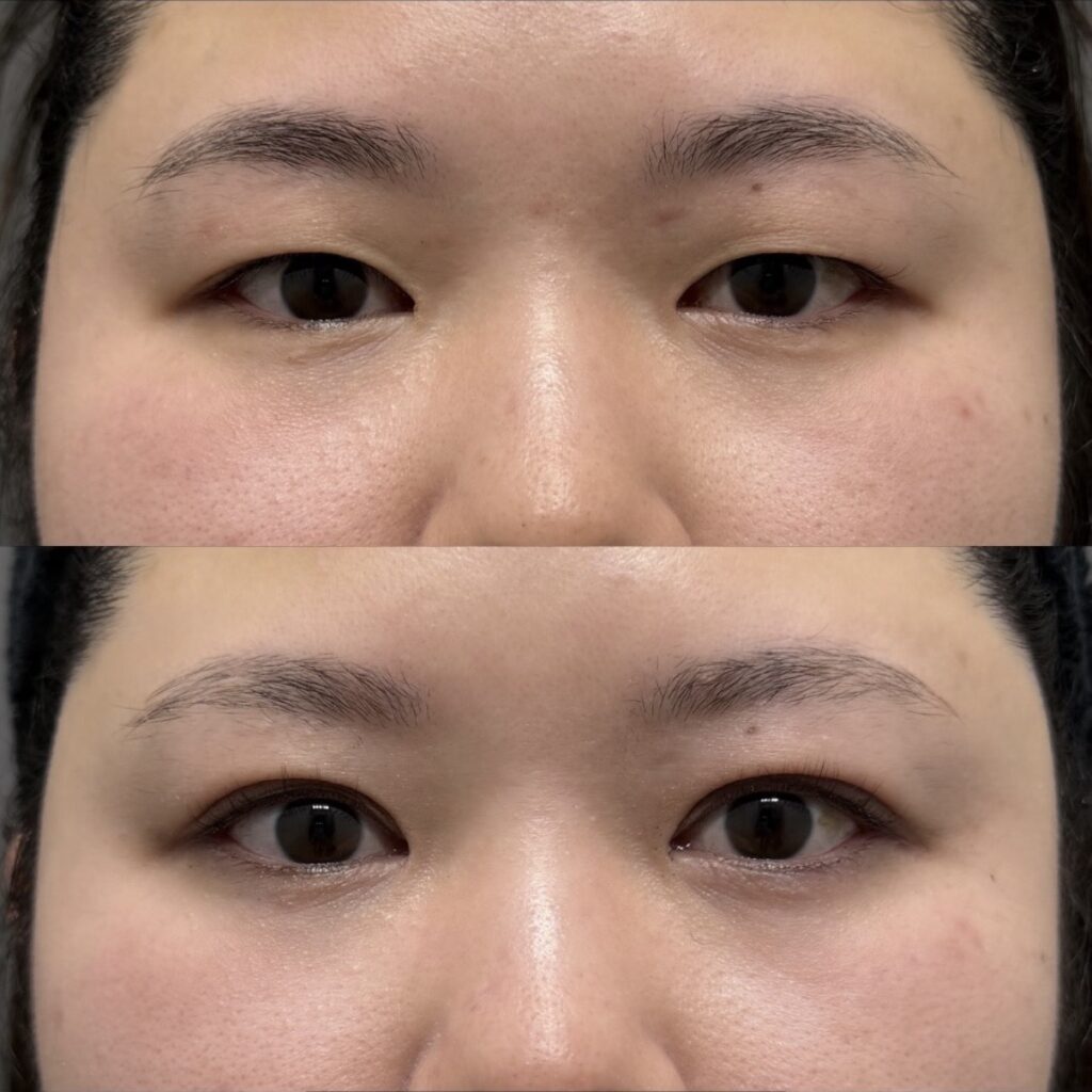 全切開二重