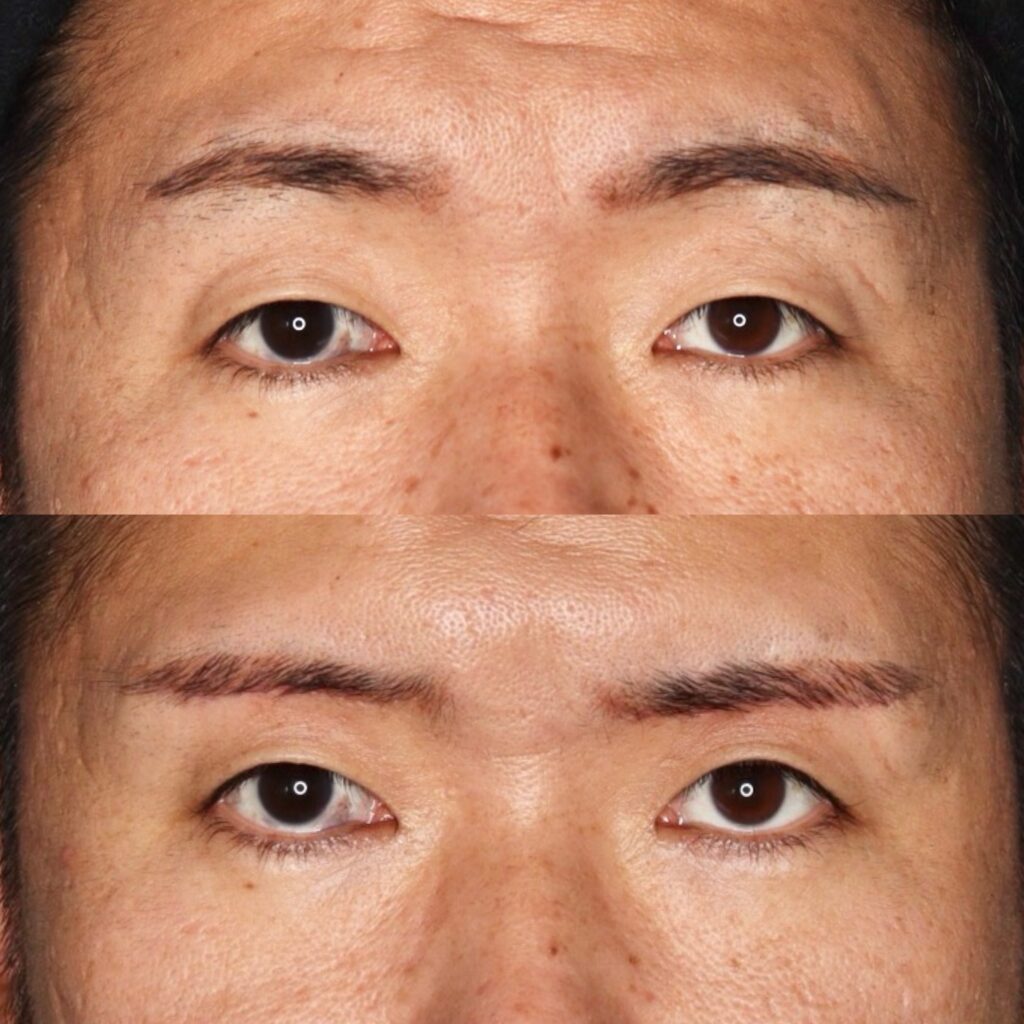 眉下切開