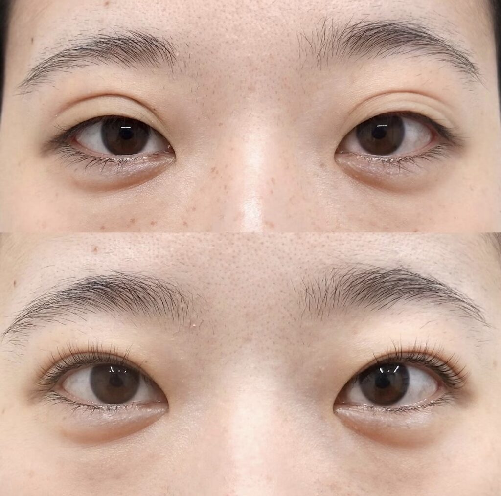 全切開、眼瞼下垂（他院埋没糸抜糸）