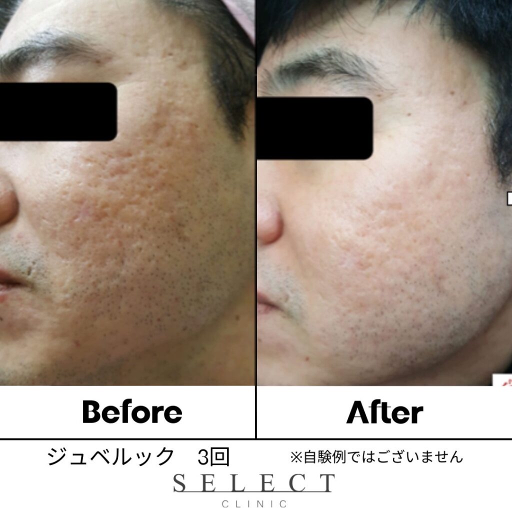 ダーマペン ジュベルック 症例