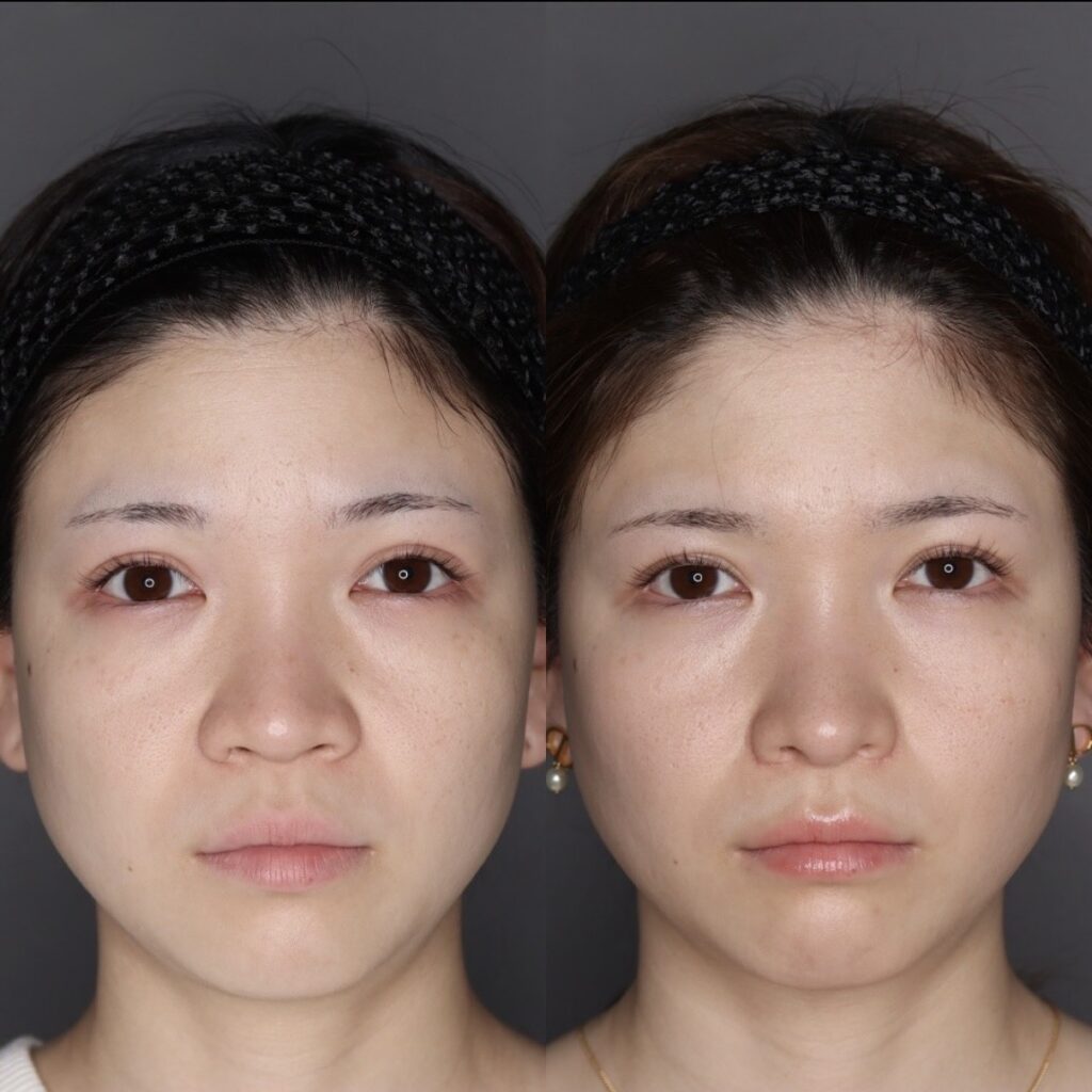 鼻中隔延長【耳介軟骨】+鼻尖形成セット+鼻翼縮小