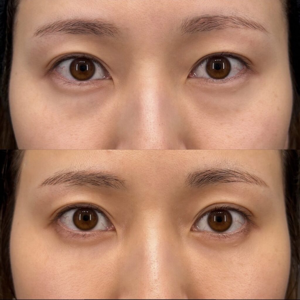裏ハムラ 症例