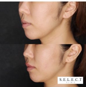 唇のヒアルロン酸 理想的なぷっくり唇を叶えるヒアルロン酸注入とは Select Clinic Tips