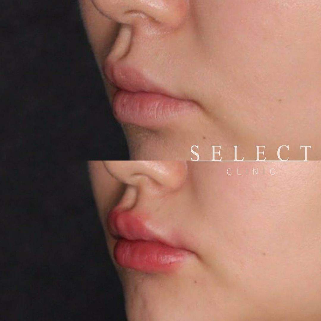 唇のヒアルロン酸 理想的なぷっくり唇を叶えるヒアルロン酸注入とは Select Clinic Tips