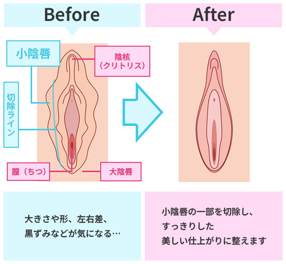 小陰唇肥大（ビラビラ）の治療。小陰唇の一部を切除して美しい小陰唇に