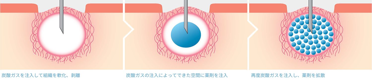 トライフィルプロ　ニキビ跡