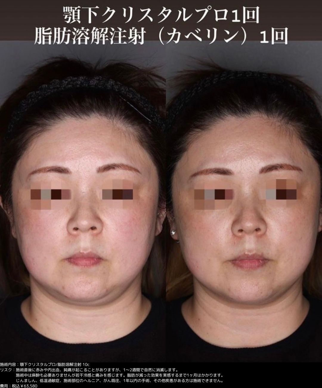 気になる部位を簡単に部分痩せするなら脂肪溶解注射がおすすめって本当 