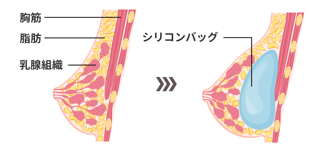 シリコン豊胸