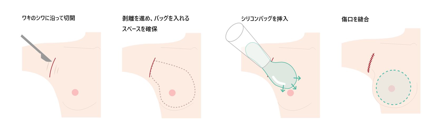 シリコン豊胸