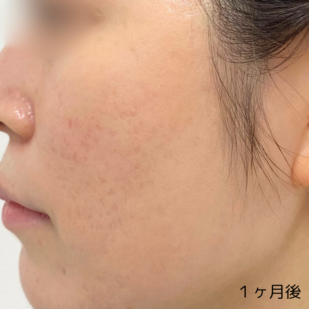 トライフィルプロ1ヶ月後 症例