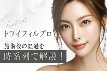 トライフィルプロ施術後の経過を時系列で解説！