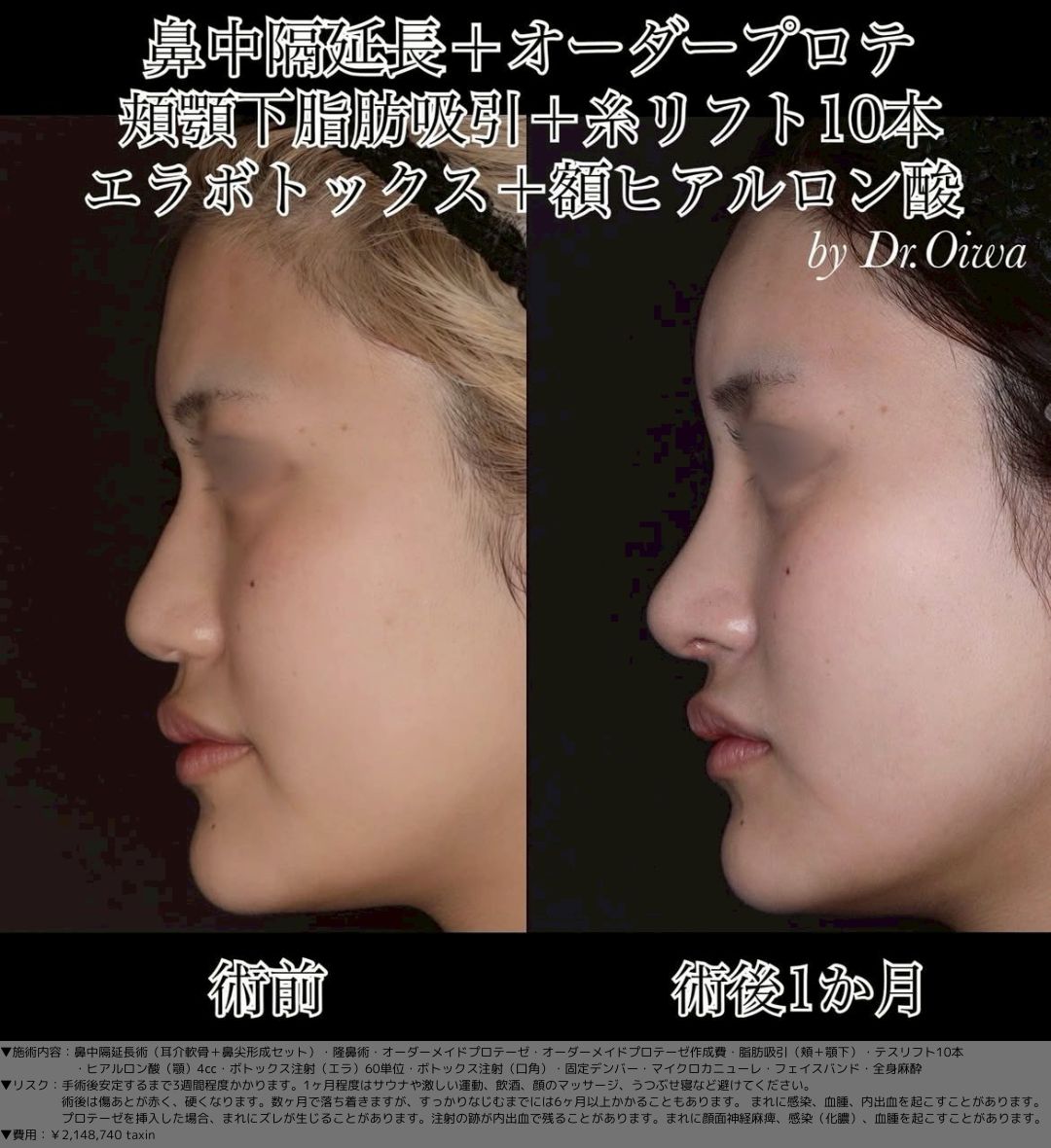 鼻中隔延長術 耳介軟骨 鼻尖形成 隆鼻術 オーダーメイドプロテーゼ 脂肪吸引 頬 顎下 テスリフト10本 ヒアルロン酸（顎）4㏄ ボトックス注射（エラ）60単位 ボトックス注射（口角） マイクロカニューレ