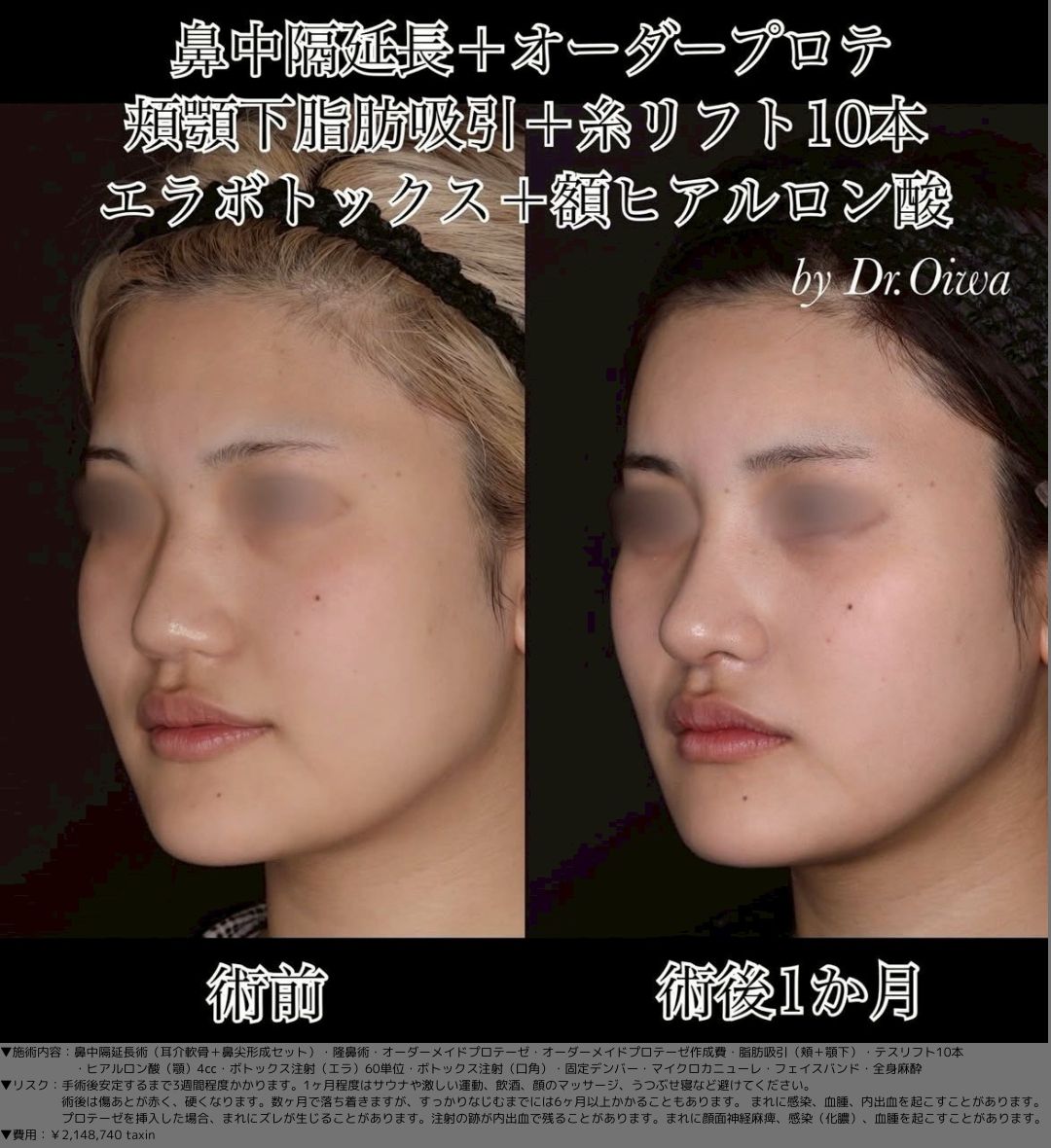 鼻中隔延長術 耳介軟骨 鼻尖形成 隆鼻術 オーダーメイドプロテーゼ 脂肪吸引 頬 顎下 テスリフト10本 ヒアルロン酸（顎）4㏄ ボトックス注射（エラ）60単位 ボトックス注射（口角） マイクロカニューレ