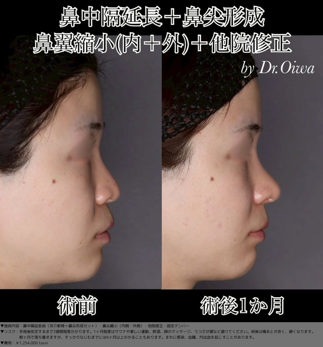 鼻中隔延長術 耳介軟骨 鼻尖形成 鼻尖縮小