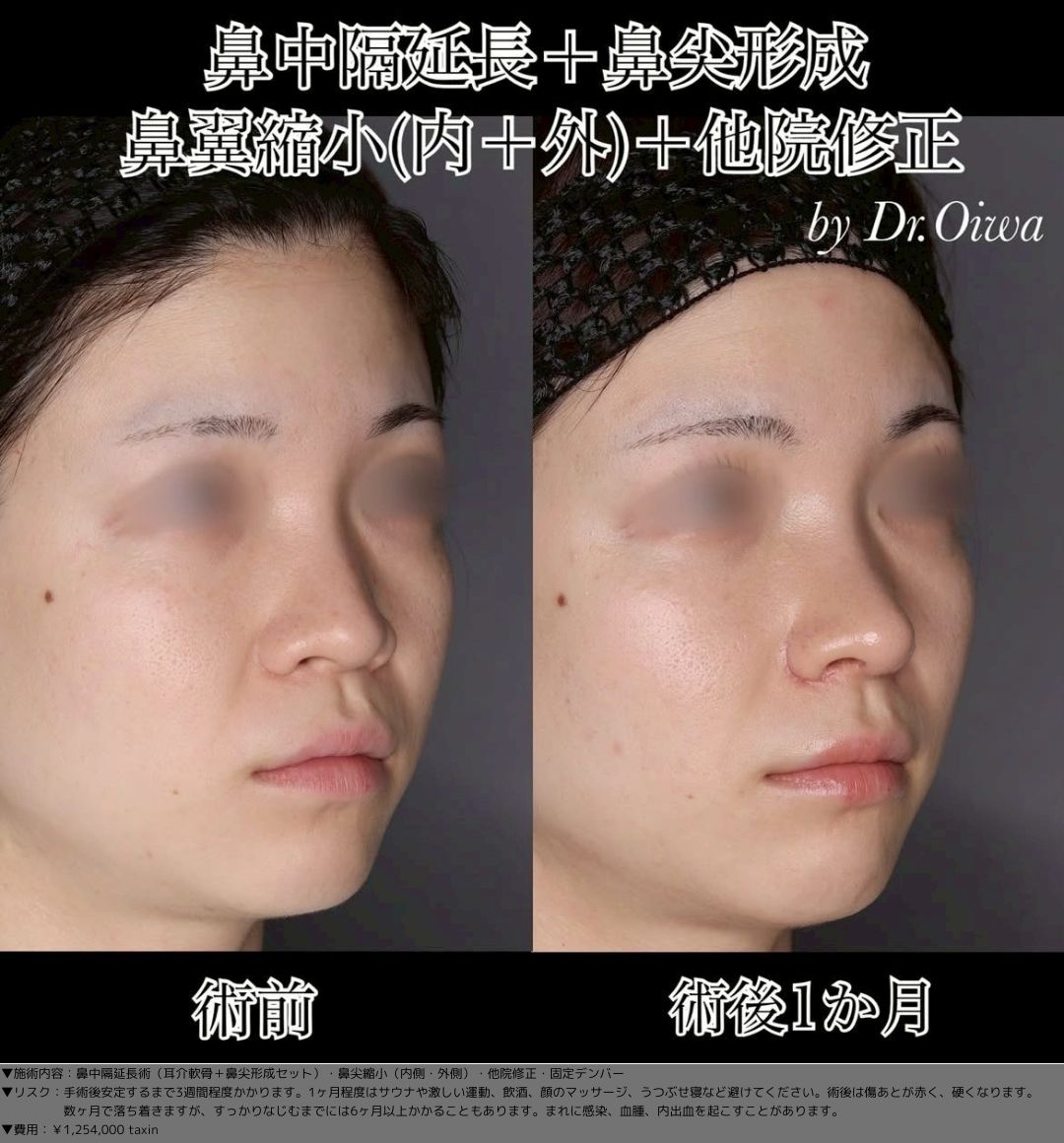 鼻中隔延長術 耳介軟骨 鼻尖形成 鼻尖縮小