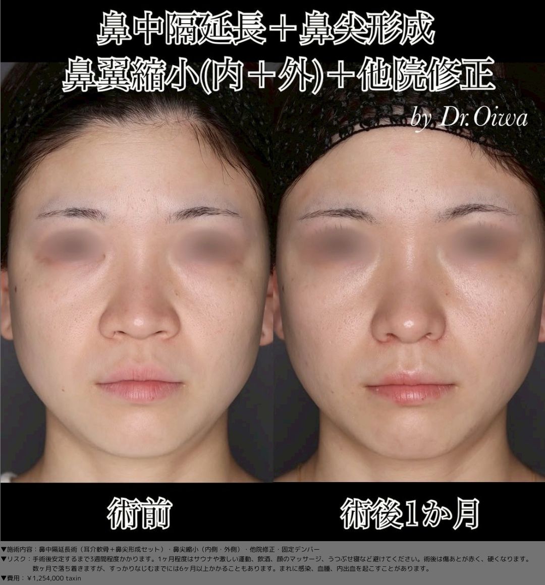 鼻中隔延長術 耳介軟骨 鼻尖形成 鼻尖縮小