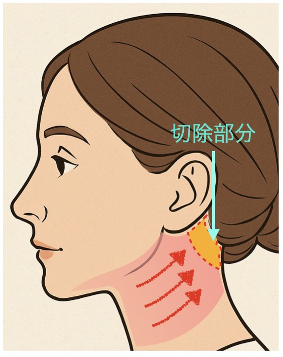 ネックリフト