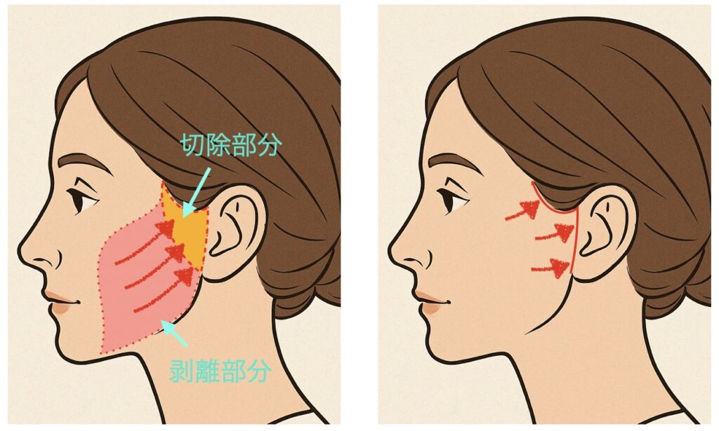 フェイスリフト
