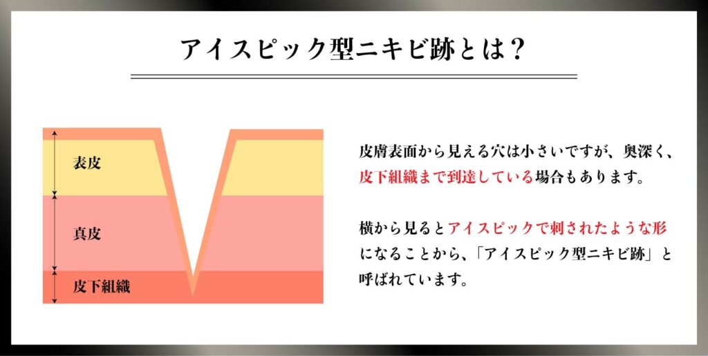 ニキビ跡 サブシジョン