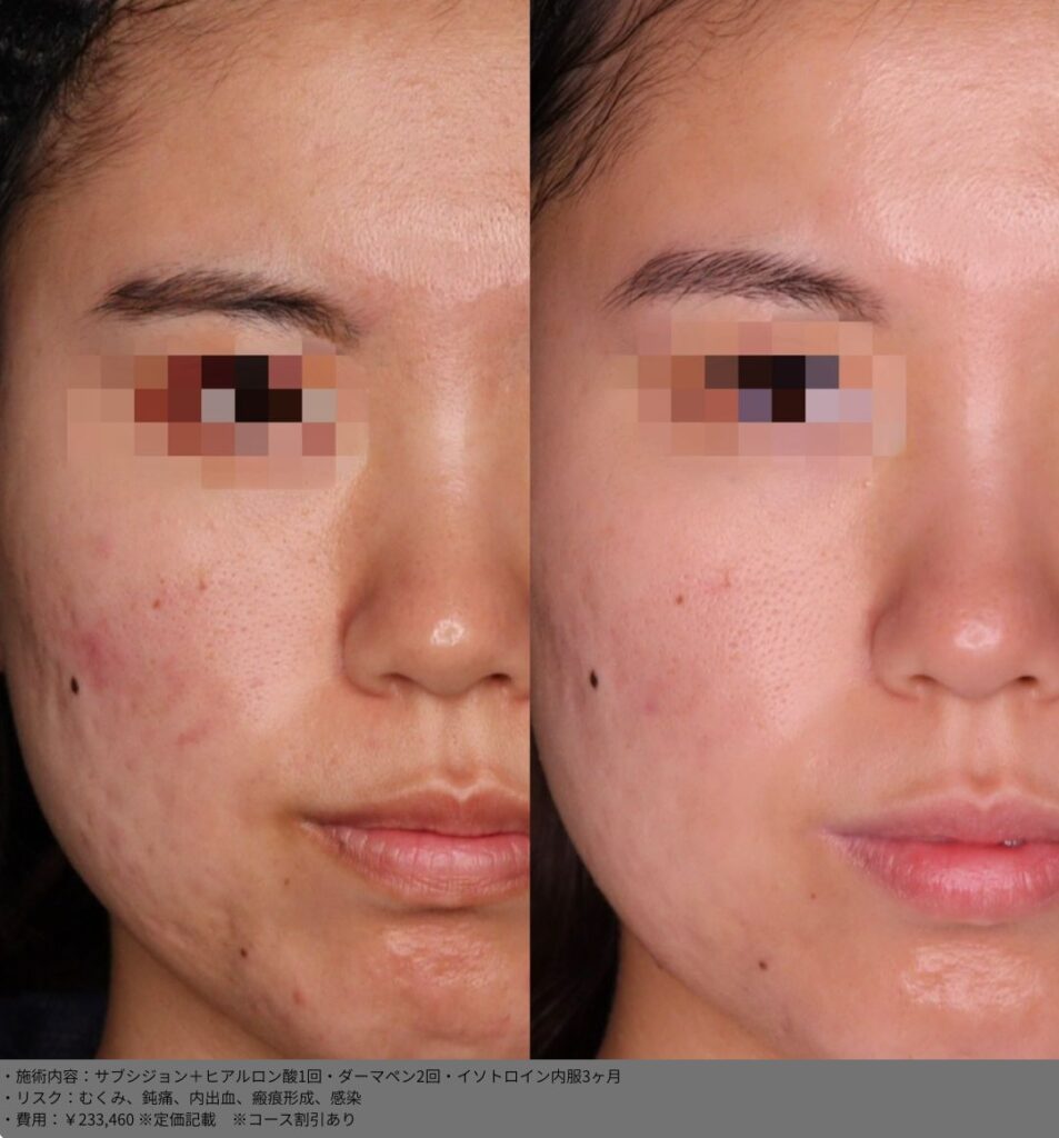 サブシジョン ヒアルロン酸 ダーマペン イソトロイン