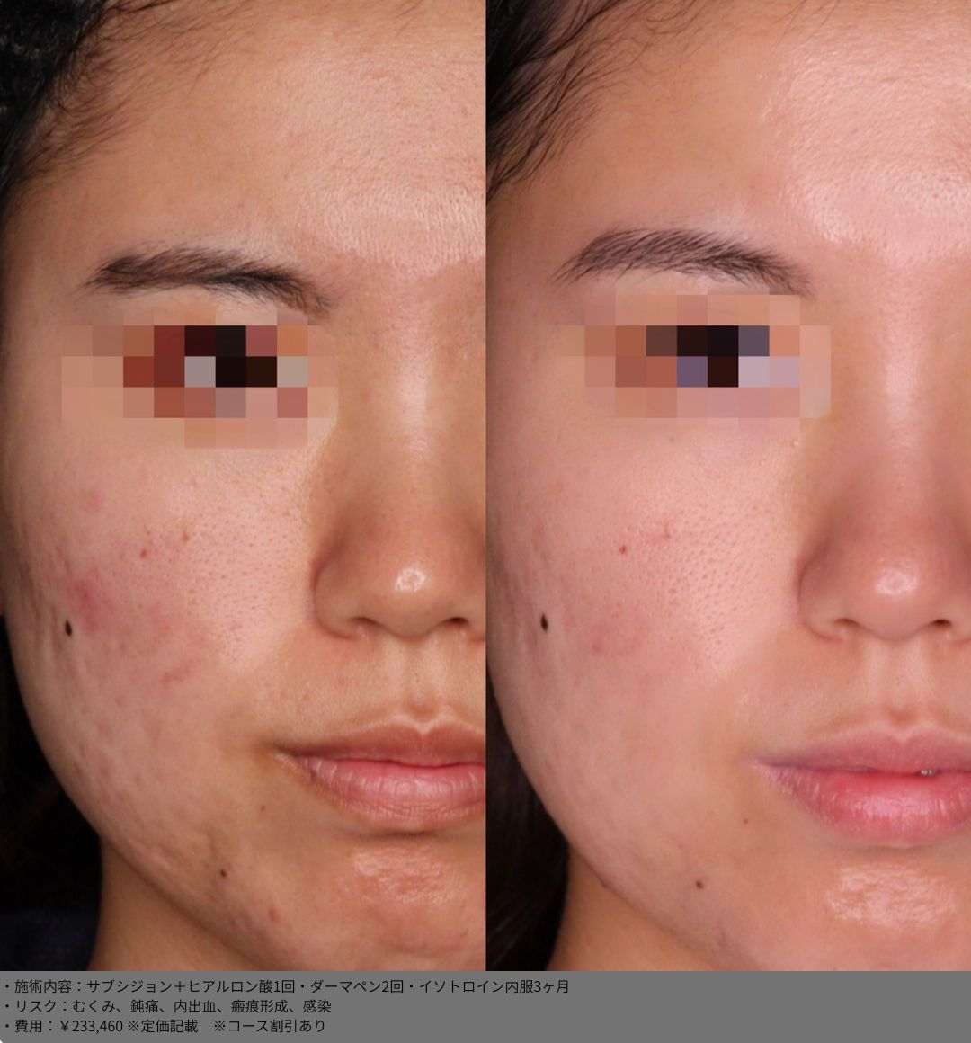 サブシジョン ヒアルロン酸 ダーマペン イソトロイン