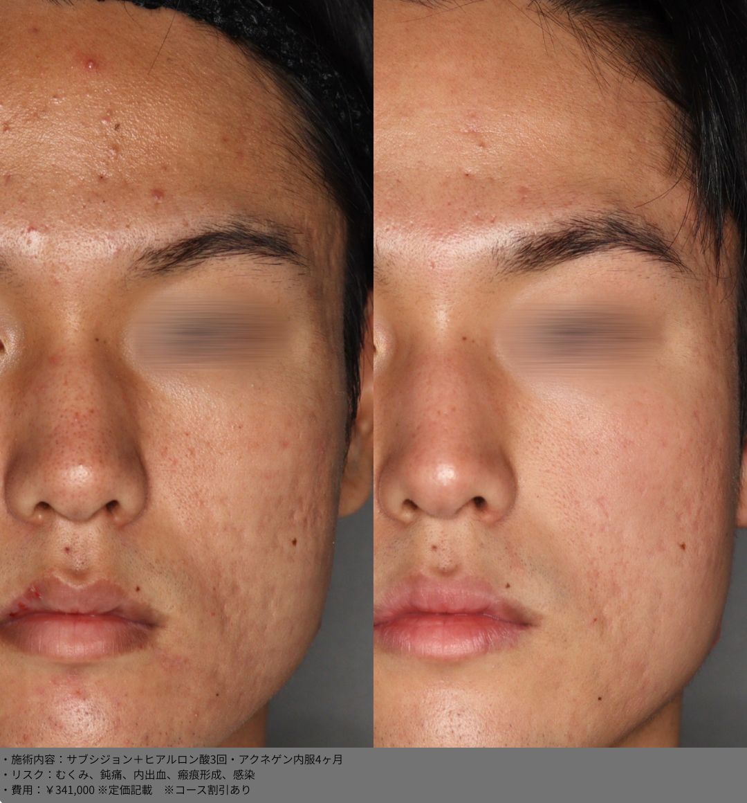 サブシジョン ヒアルロン酸 アクネゲン