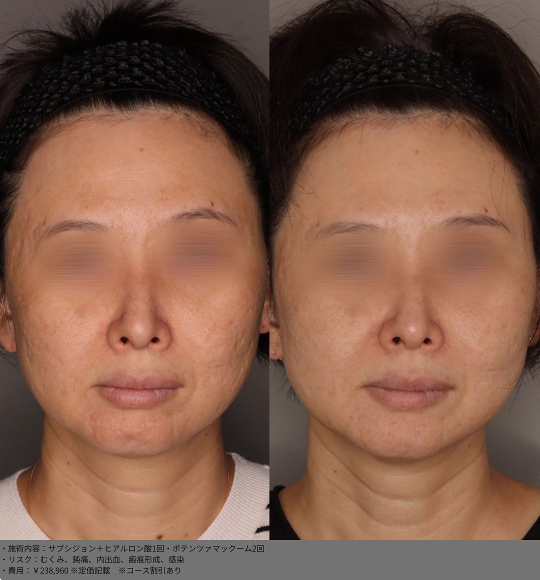サブシジョン ヒアルロン酸 ポテンツァマックーム