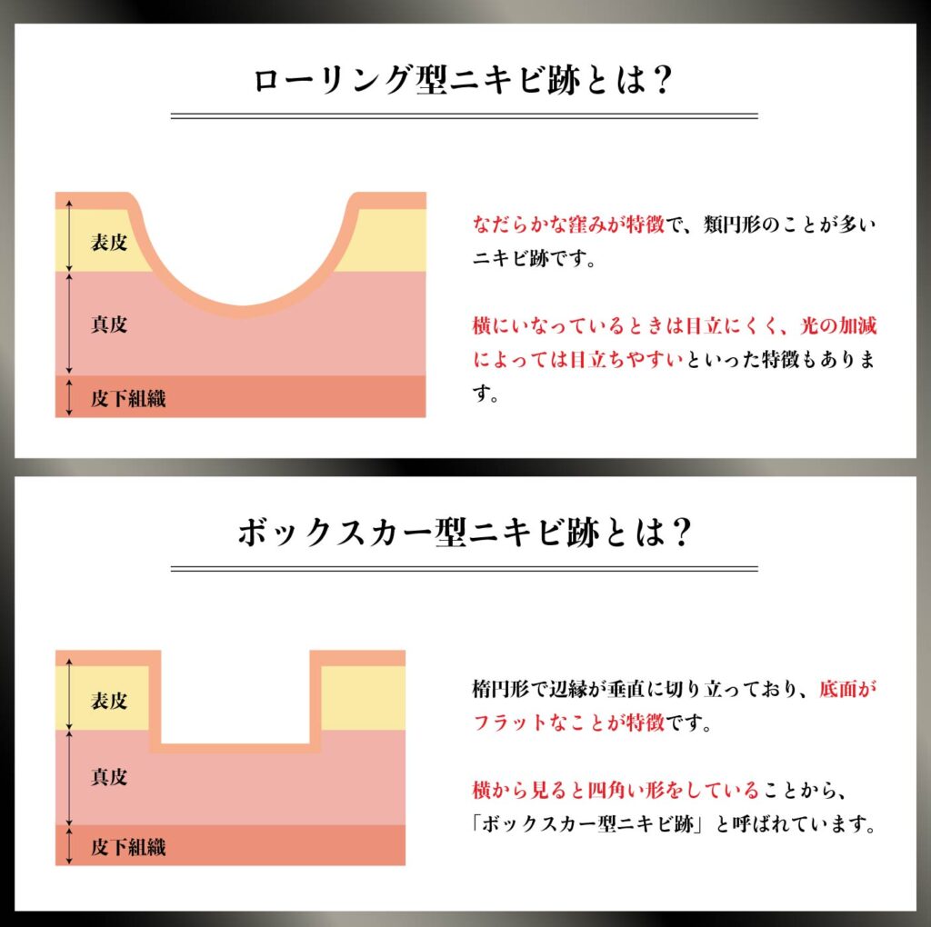 ニキビ跡　ローリング型　ボックスカー型