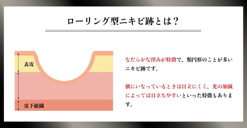 ローリング型ニキビ跡