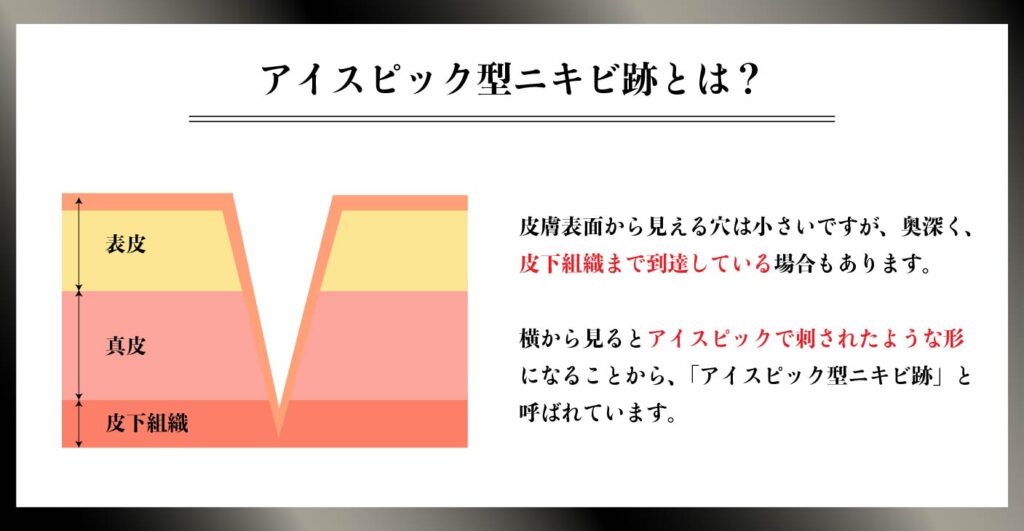 アイスピック型ニキビ跡