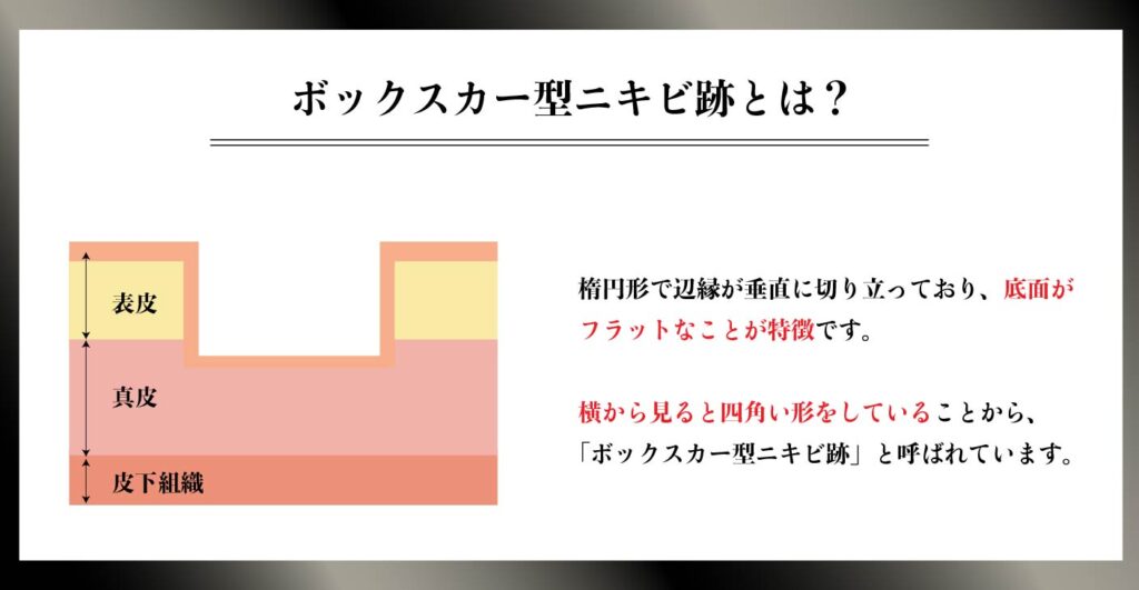 ボックスカー型ニキビ跡