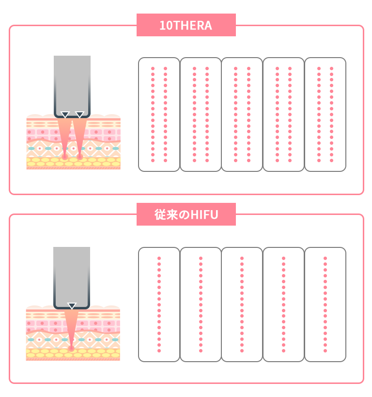 テンセラ2ライン同時照射