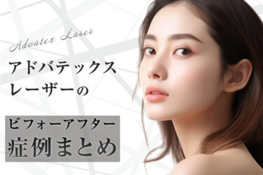 アドバテックスレーザーのビフォーアフター症例まとめ