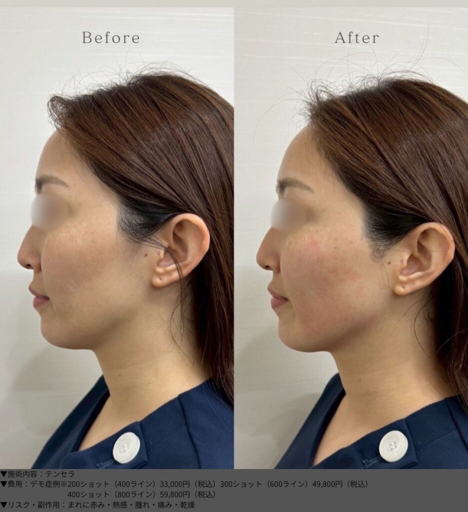 テンセラ ビフォーアフター