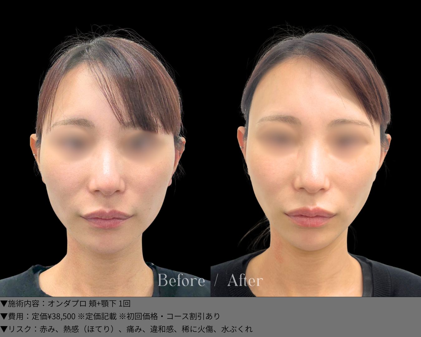 オンダプロ 症例