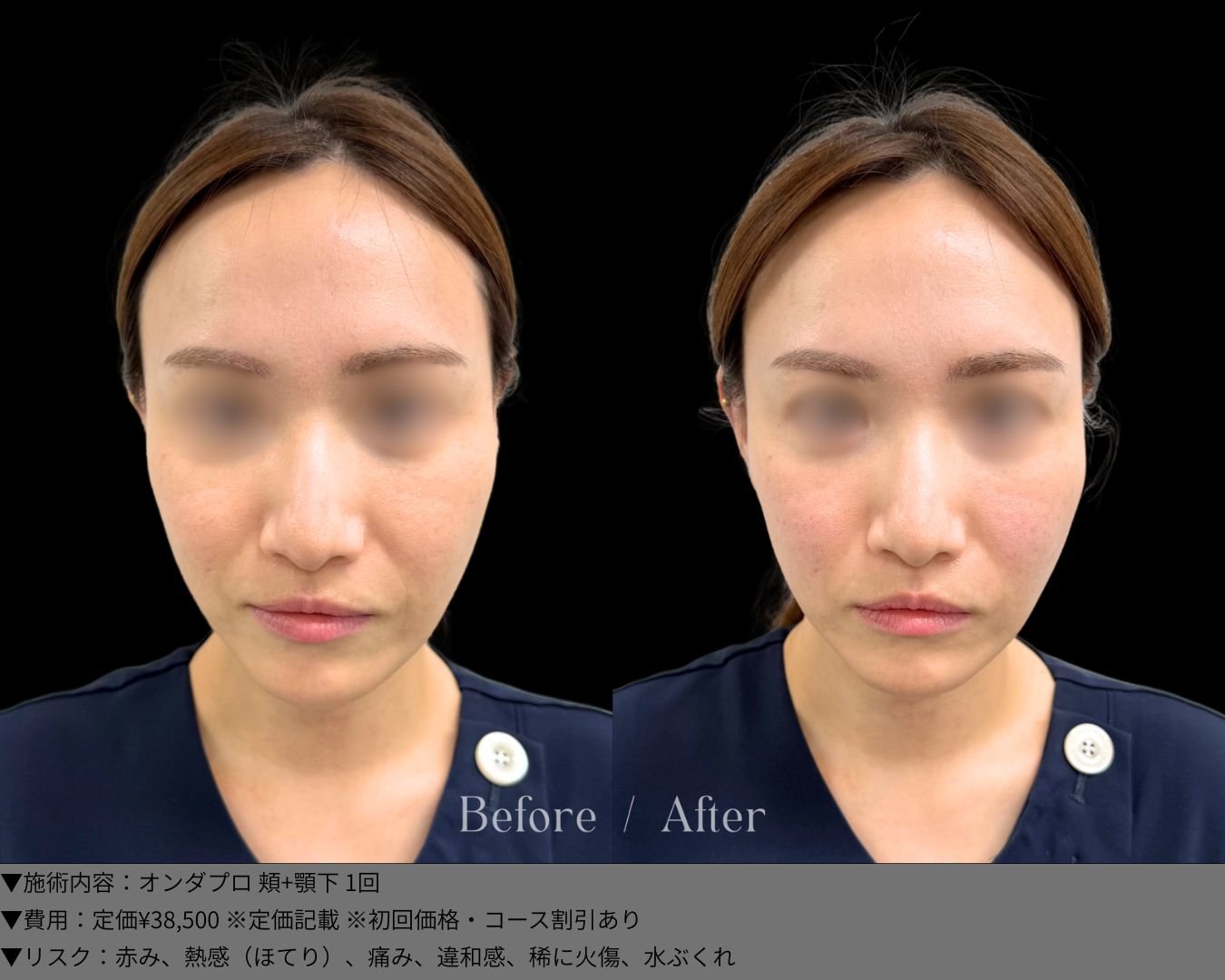 オンダプロ 症例