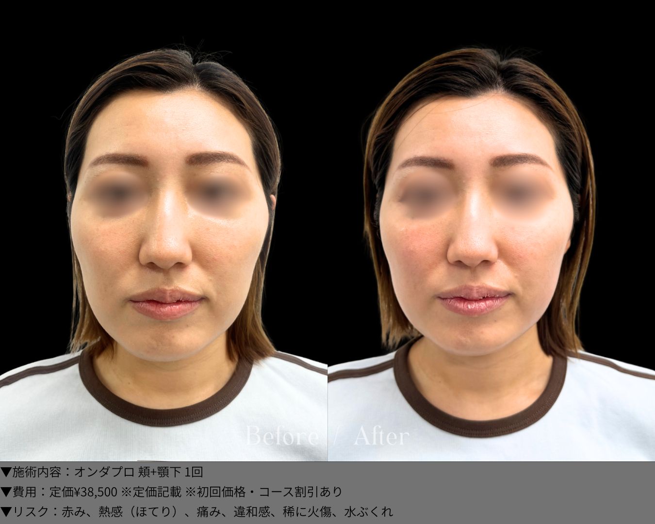 オンダプロ 症例