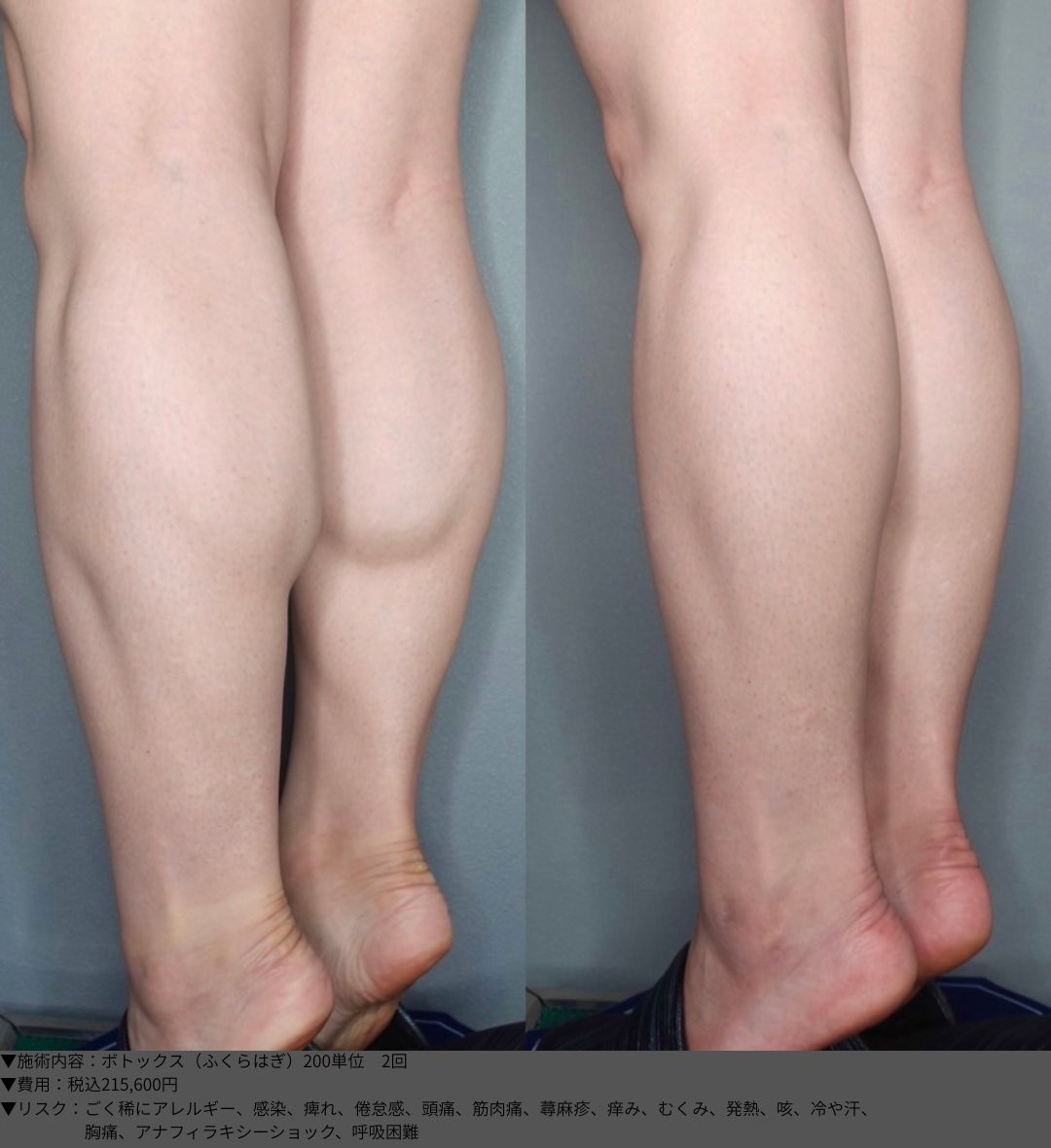 ボトックス ふくらはぎ