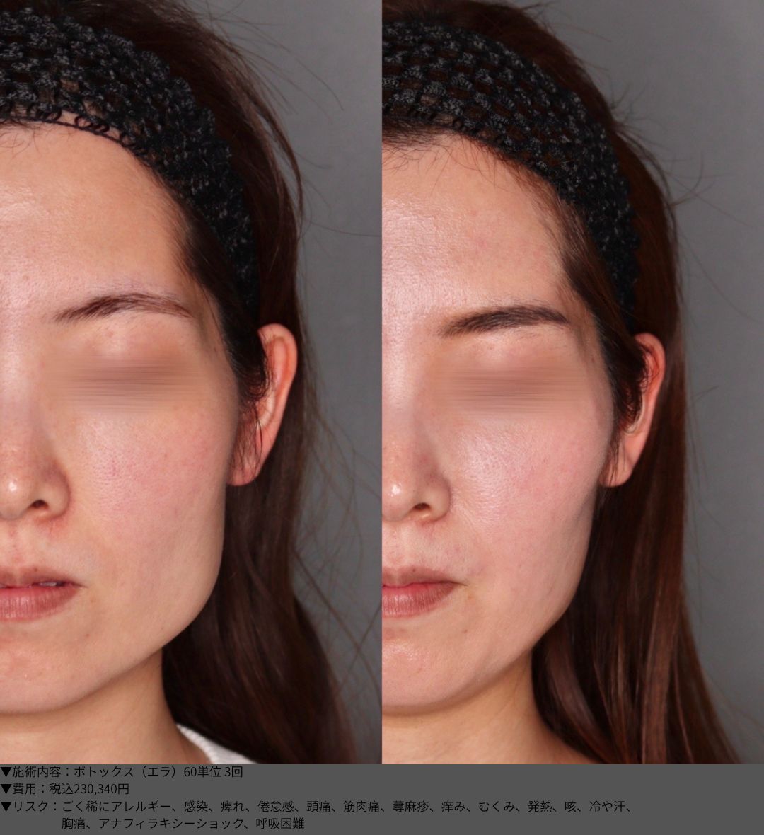 ボトックス エラ