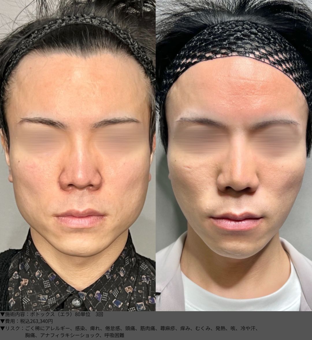 ボトックス エラ