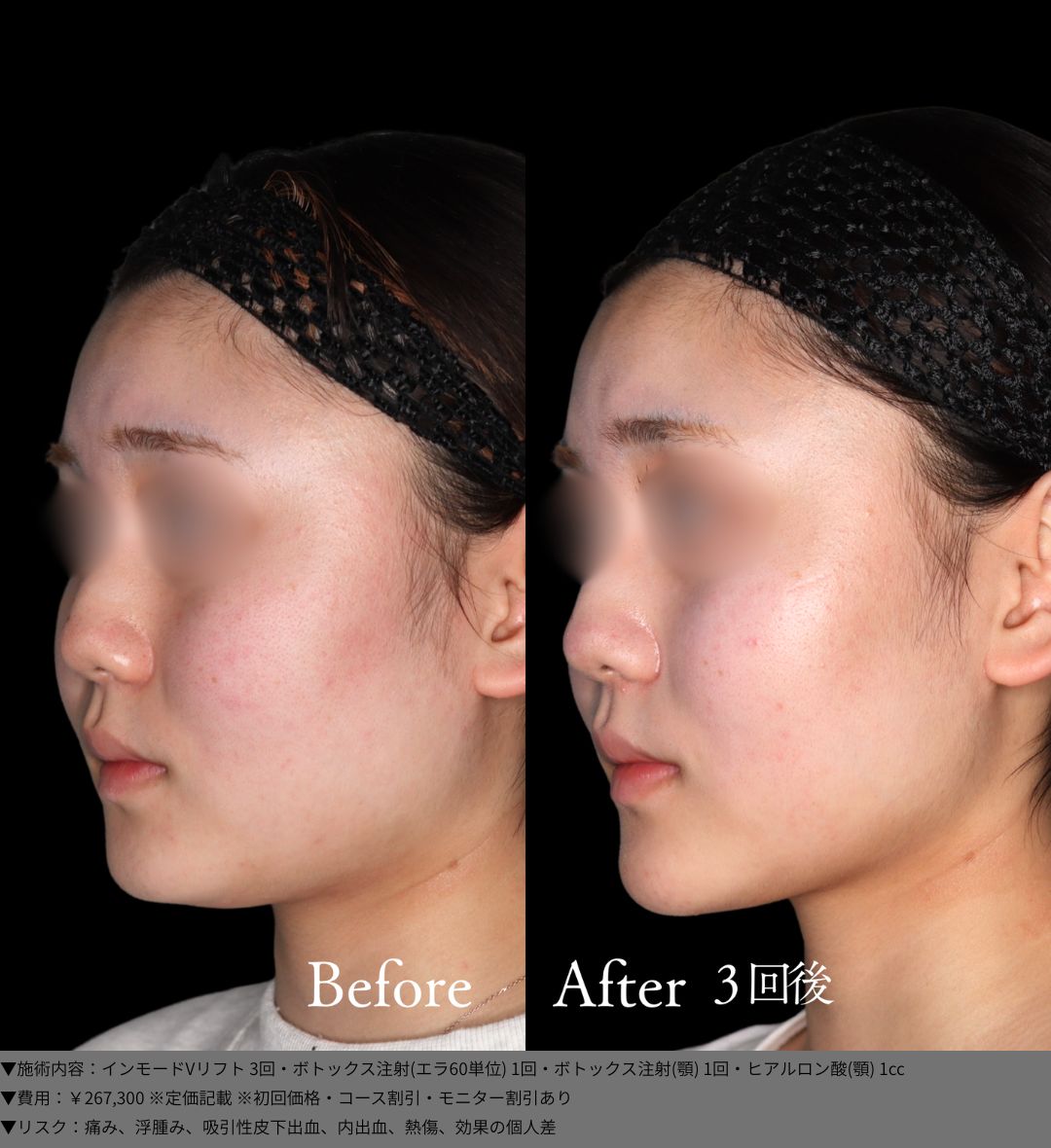 インモードVリフト ボトックス ヒアルロン酸 症例