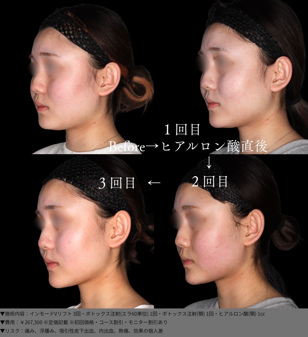 インモードVリフト ボトックス ヒアルロン酸 症例