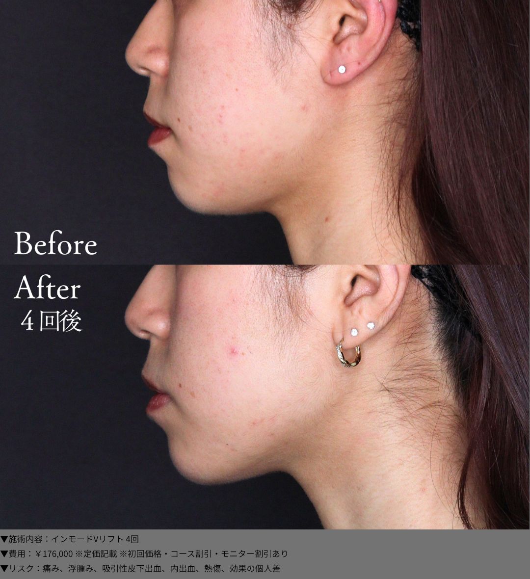 インモードVリフト 症例