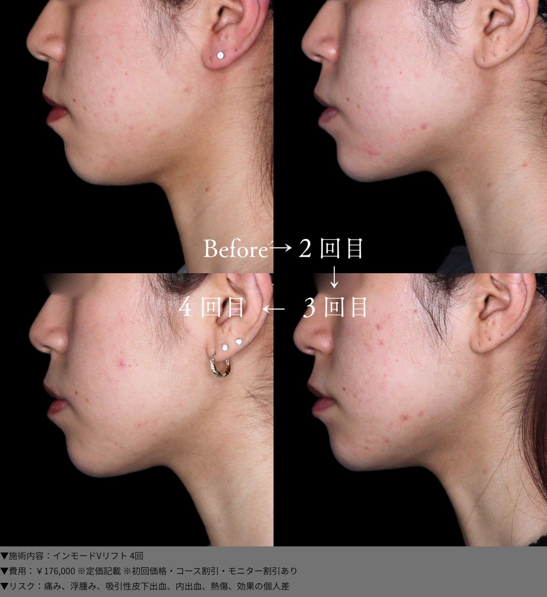 インモードVリフト 症例