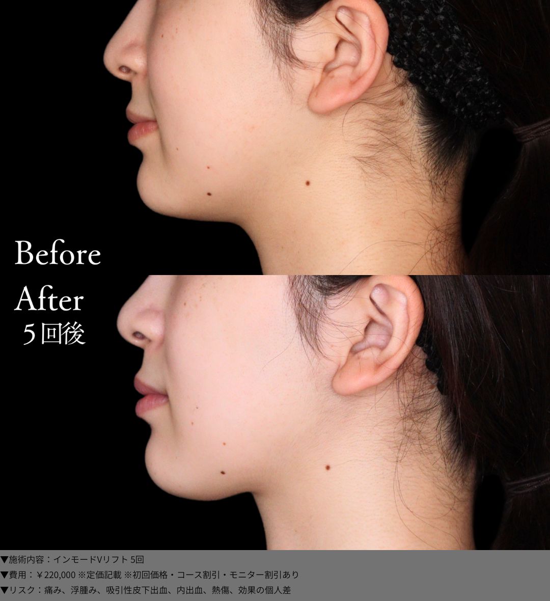 インモードVリフト 症例