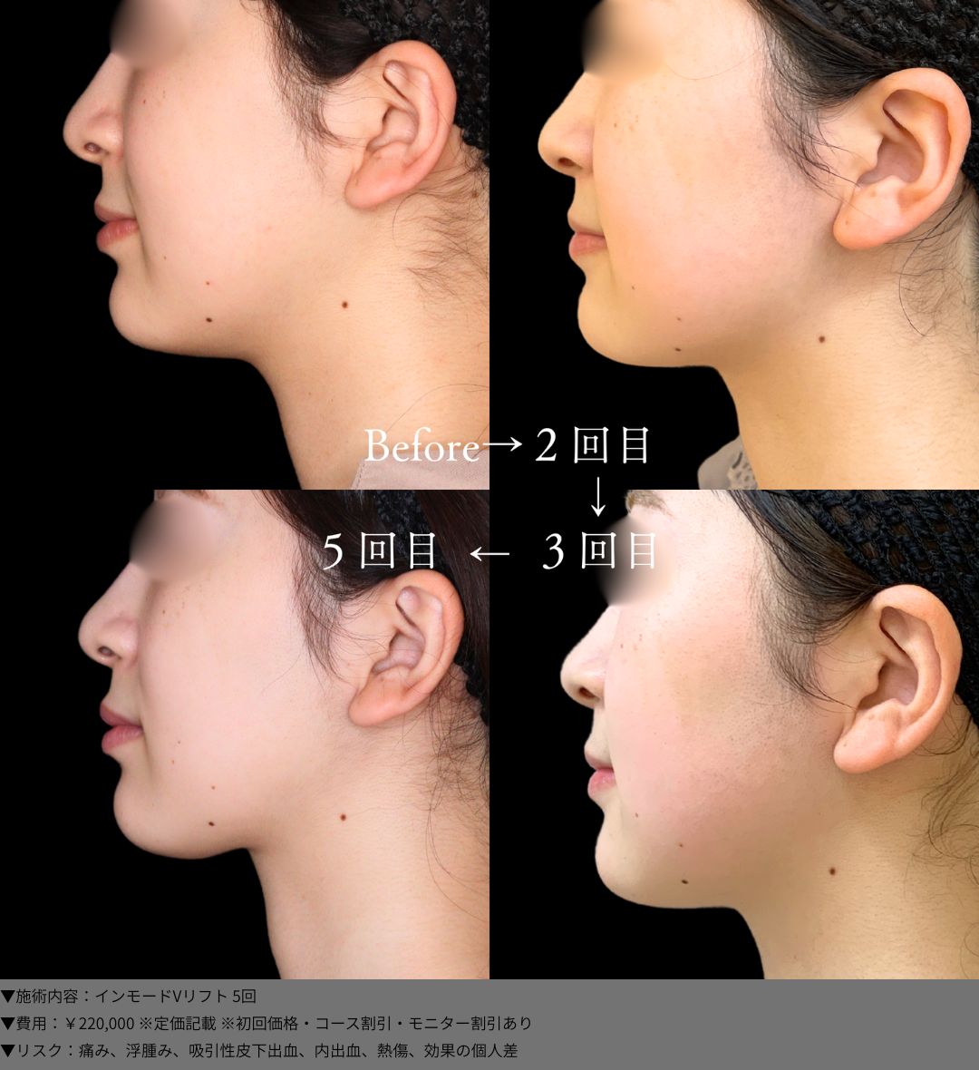 インモードVリフト 症例