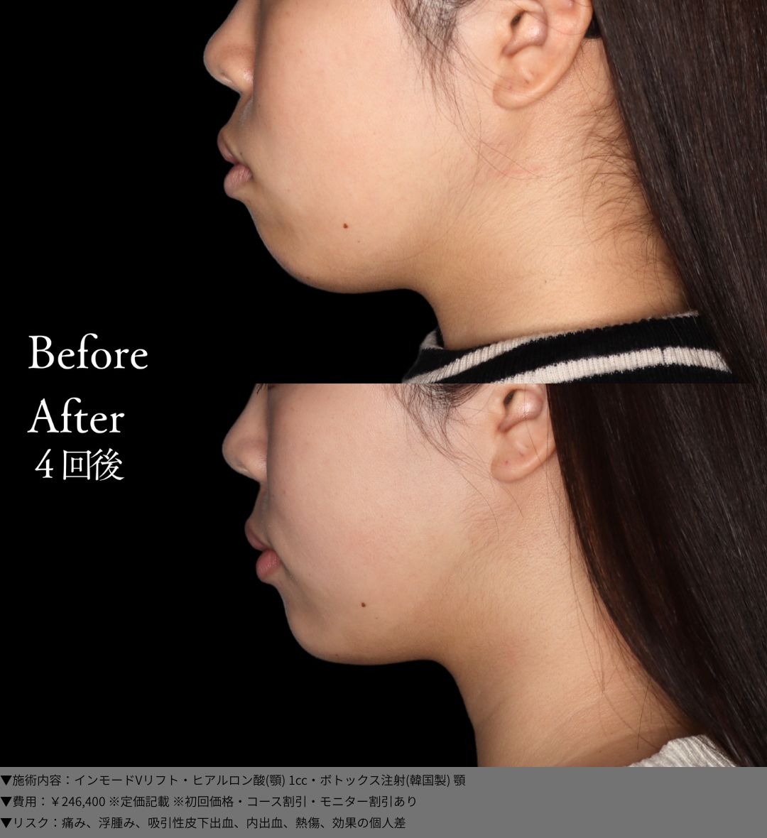 インモードVリフト ヒアルロン酸 ボトックス 症例