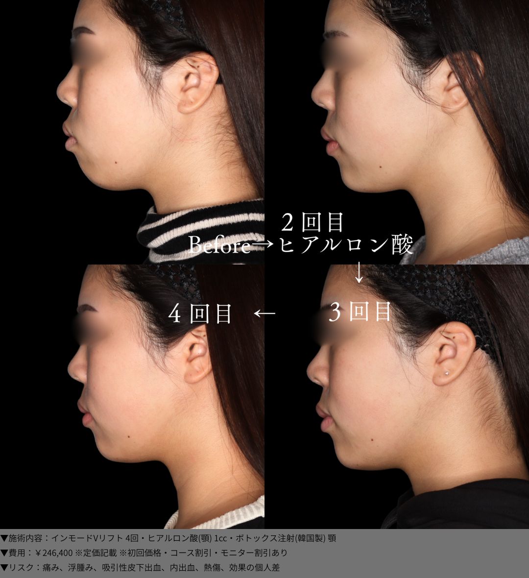 インモードVリフト ヒアルロン酸 ボトックス 症例