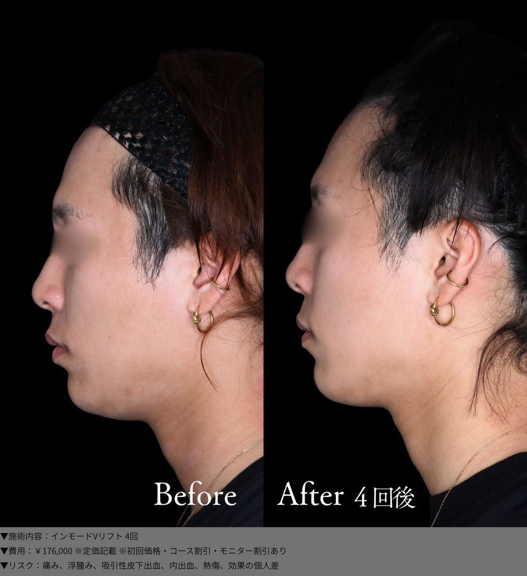 インモードVリフト 症例